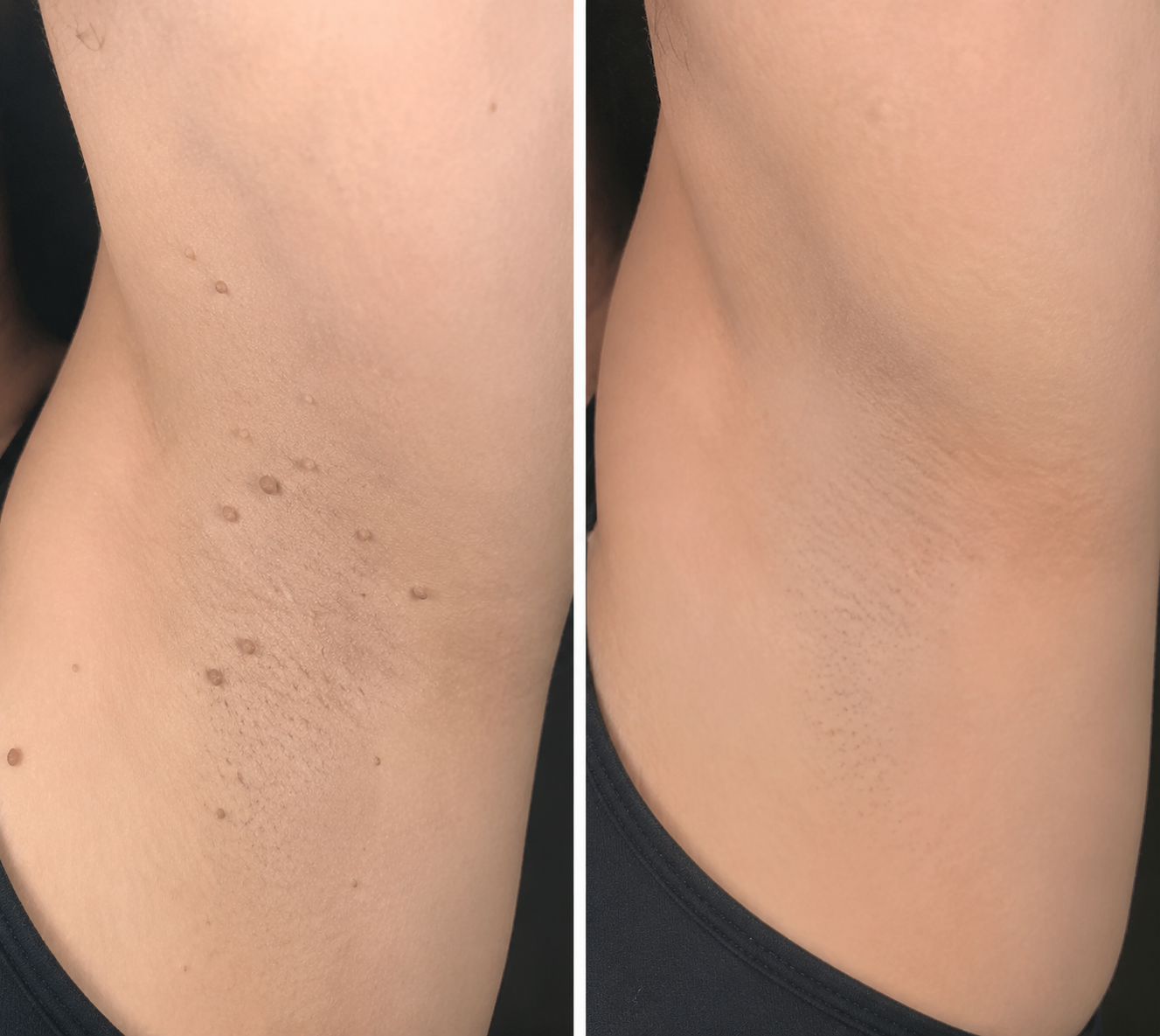 🏥Curalona®2-in-1 Microneedle & Hydrocolloid Patch🍀| Removes Raised Moles, Acne, Flat Warts & Skin Tags | Helps Improve Wrinkles, Scars & Blemishes | Invisible Patches for Face & Body