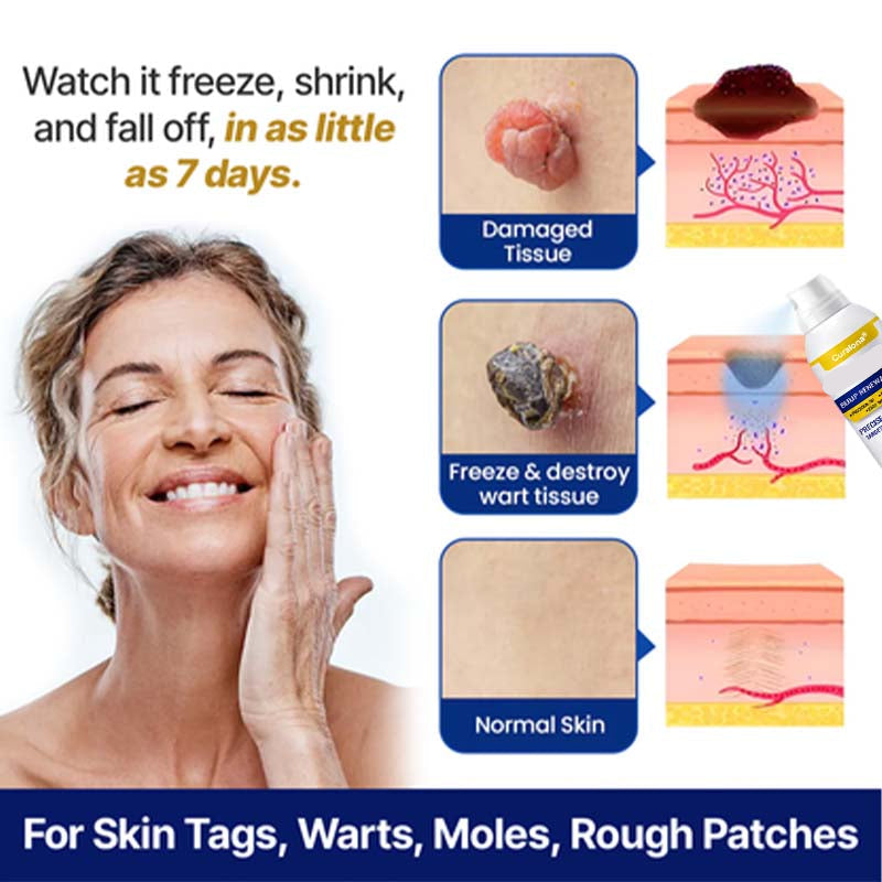 Curalona® Bump Renewal Spray - Skin tags, warts, & moles falling off in 7 days or less.