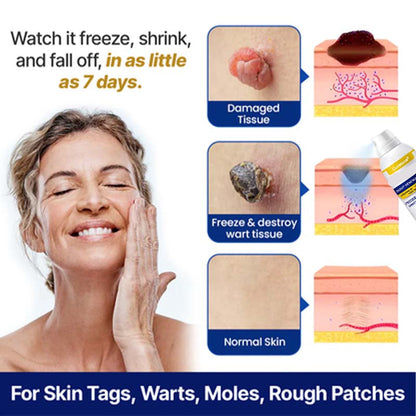 Curalona® Bump Renewal Spray - Skin tags, warts, & moles falling off in 7 days or less.
