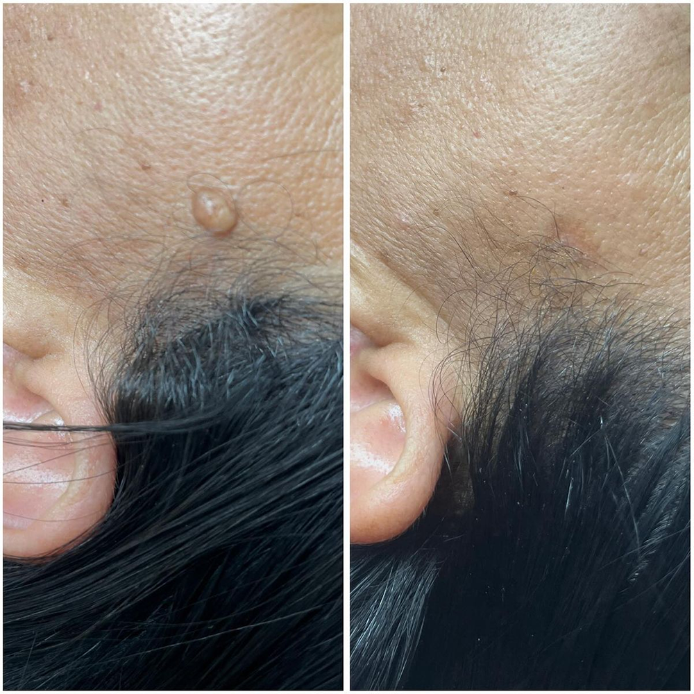 ✨【Dermatologist-Inspired】PURELORA® Bump Eraser Micro-Infusion Patches——For Bumps, Rough Spots, Wart-Like Texture, Blemishes, Fine Lines & Dark Spots