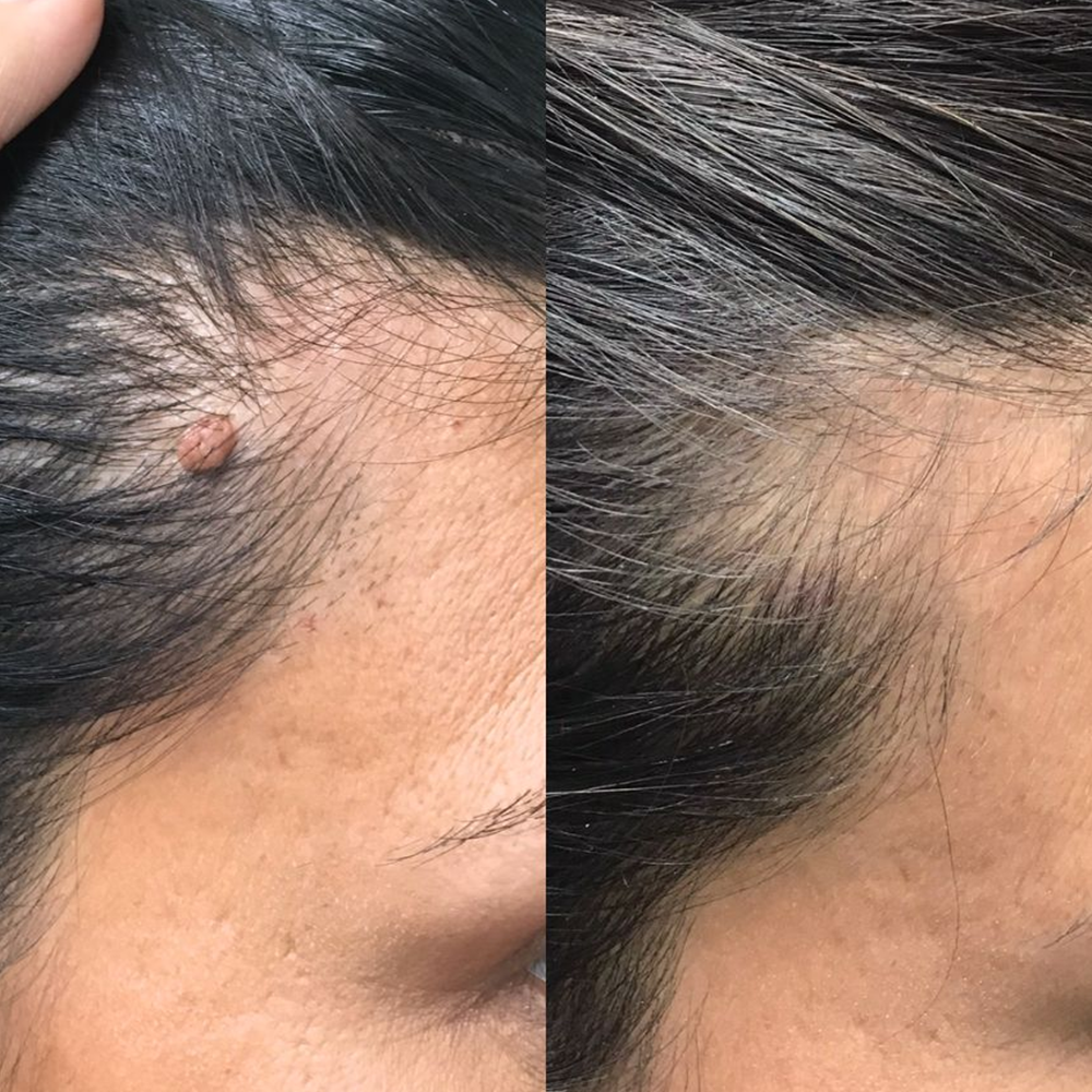 ✨【Dermatologist-Inspired】PURELORA® Bump Eraser Micro-Infusion Patches——For Bumps, Rough Spots, Wart-Like Texture, Blemishes, Fine Lines & Dark Spots