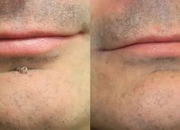 🔥Curalona®2-in-1 Microneedle & Hydrocolloid Patch🍀| Removes Raised Moles, Acne, Flat Warts & Skin Tags | Helps Improve Wrinkles, Scars & Blemishes | Invisible Patches for Face & Body