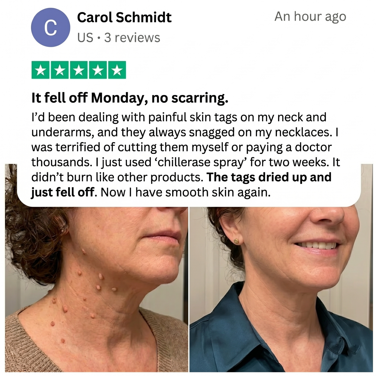 Curalona® Bump Renewal Spray - Skin tags, warts, & moles falling off in 7 days or less.