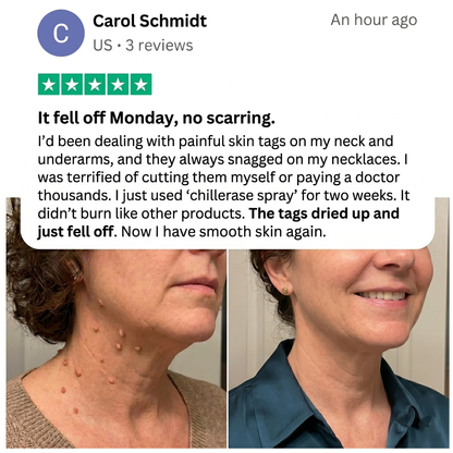 Curalona® Bump Renewal Spray - Skin tags, warts, & moles falling off in 7 days or less.