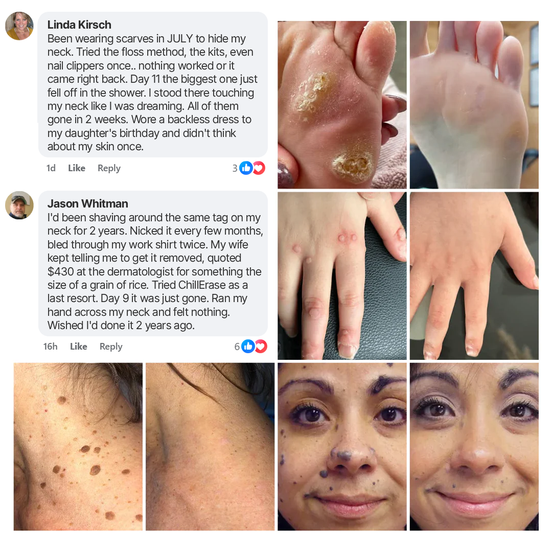 Curalona® Bump Renewal Spray - Skin tags, warts, & moles falling off in 7 days or less.